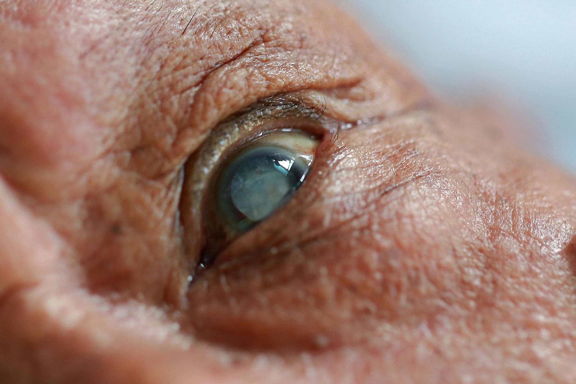 close up Cataract concept.selective focus.